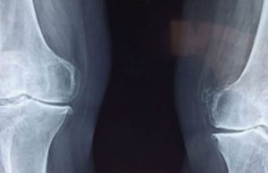 It is a rare disease